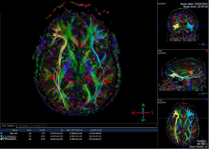 cerebro
